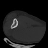 SPORK, NICO - 22.03.1976 - 02.08.2022 - CT obere Extremität - 17:59:38